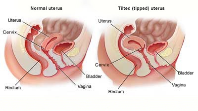 Winter reccomend Sex position with inverted uterus