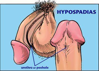 Male urology conditions pee hole