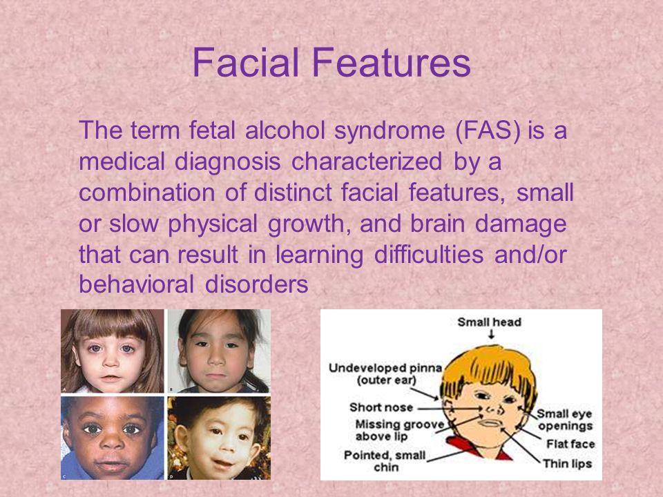 Facial characteristics genetic disorders downturned mouth