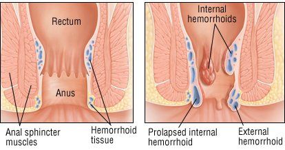 best of Herpes Hemorroids anal