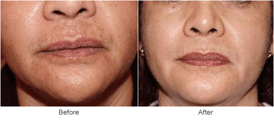 Chemical peel facial epidermal photos