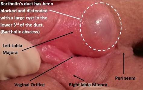 Sabriel reccomend Abcsess on my clitoris