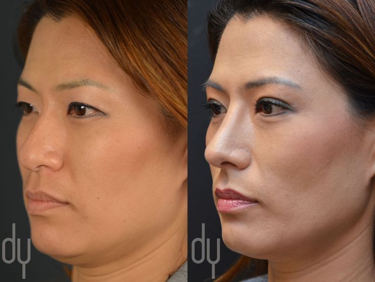Uncle reccomend Asian rhinoplasty before and after