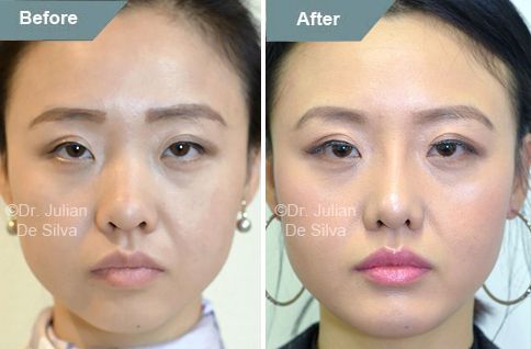 Bulldog reccomend Asian rhinoplasty before and after