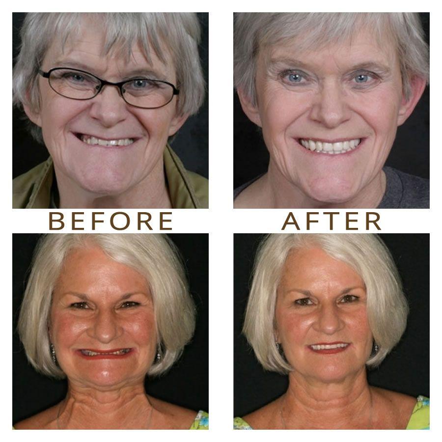 best of Help facial appearance can dentures How