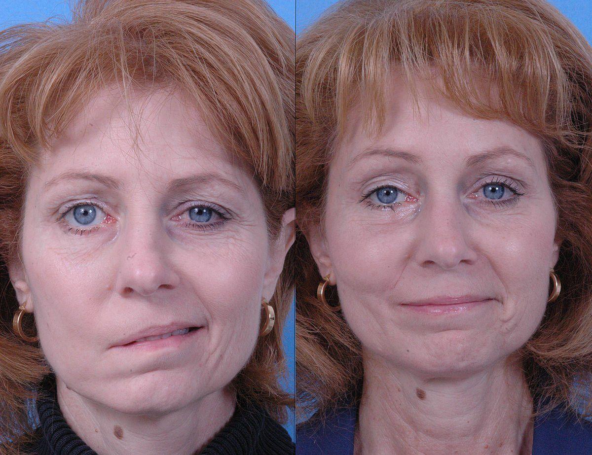 best of Synkinesis lengthening muscles Facial