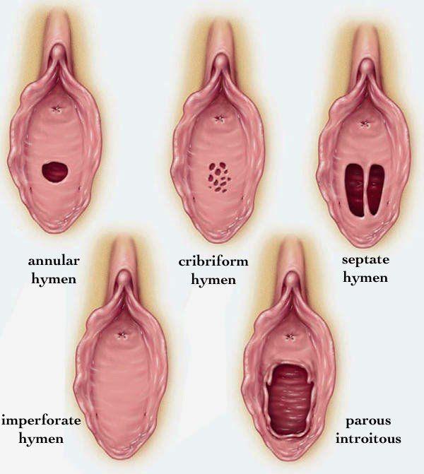 How deep in the vagina is the hymen