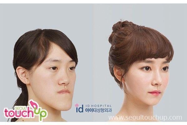 Asian face reconstructive surgery