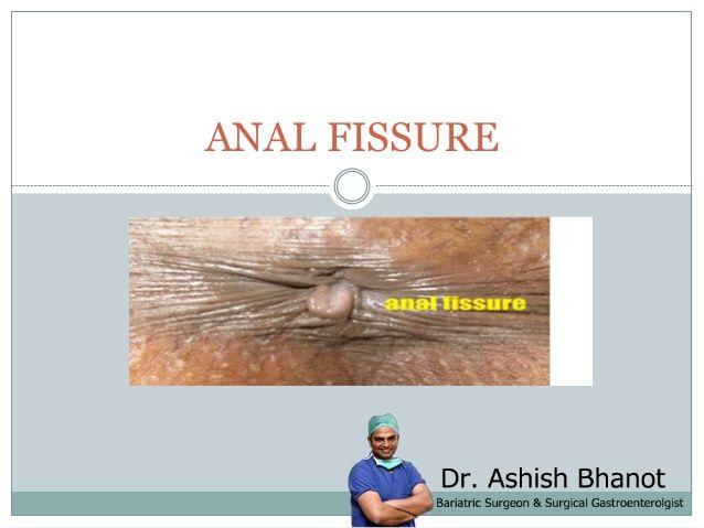 best of You an do How anal fissure treat