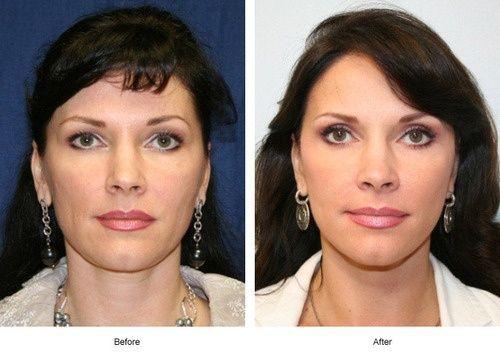 Bluegrass facial plastic surgery