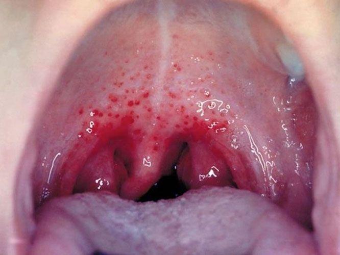 Lord C. reccomend Sore throat gonorrhea oral sex