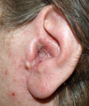 best of Edema pain Facial ear