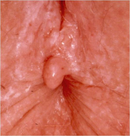 Bad M. F. reccomend Hard nodule on anus