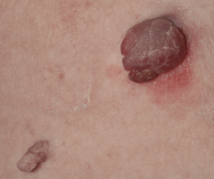 Sierra reccomend Skin tag hanging out of anus