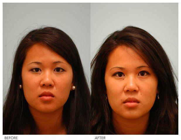 Asian face reconstructive surgery