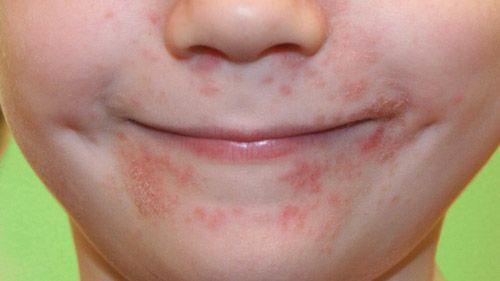 best of Facial dermatitis Perio