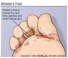Peeing on athletes feet