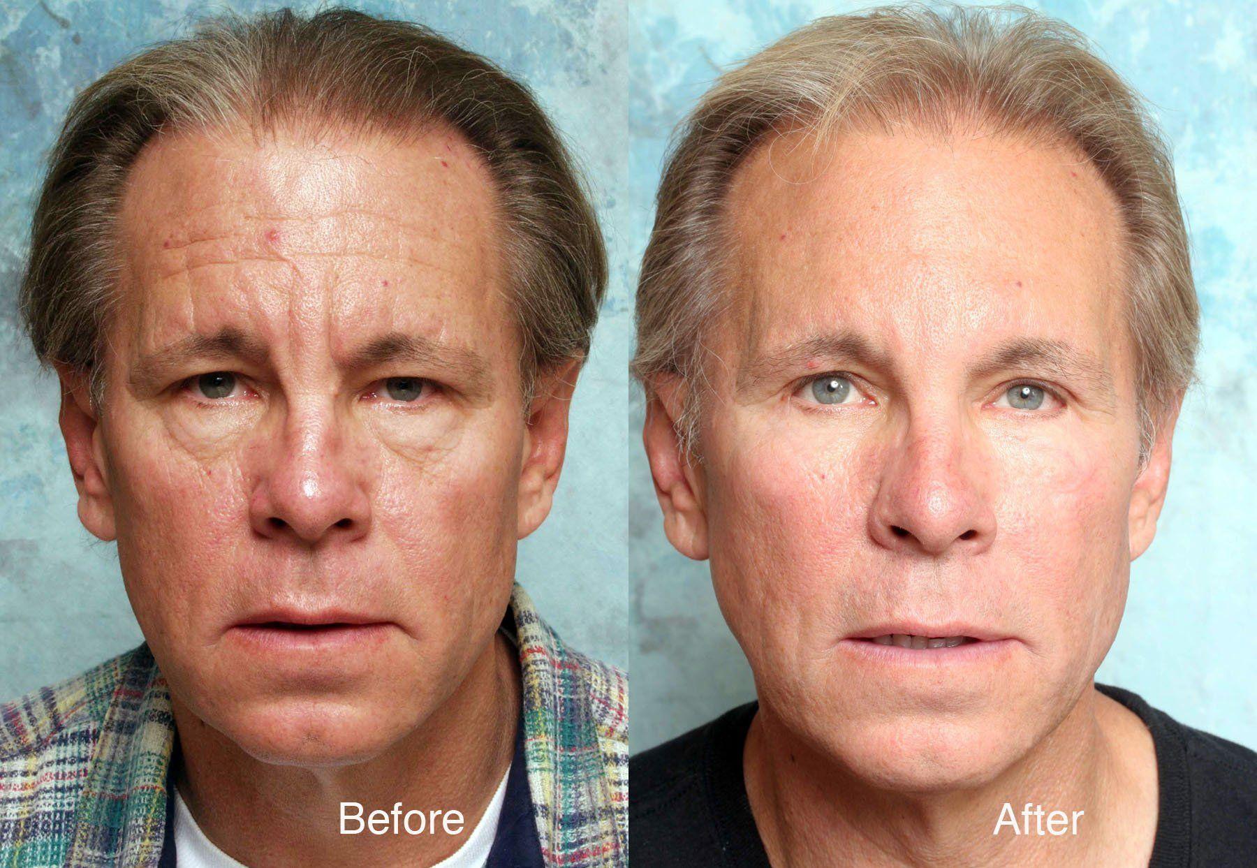 best of Procedures Facial rejuvanation