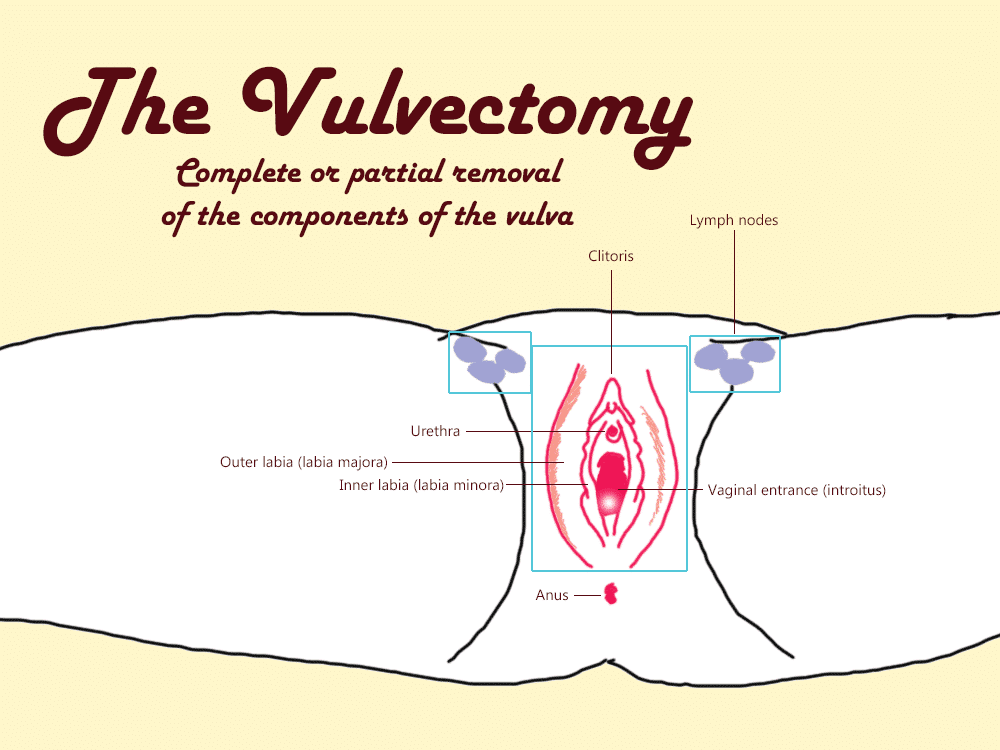 best of Cause numbness Can vagina surgury