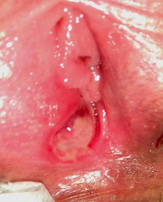Hat T. reccomend Ulcer on vulva