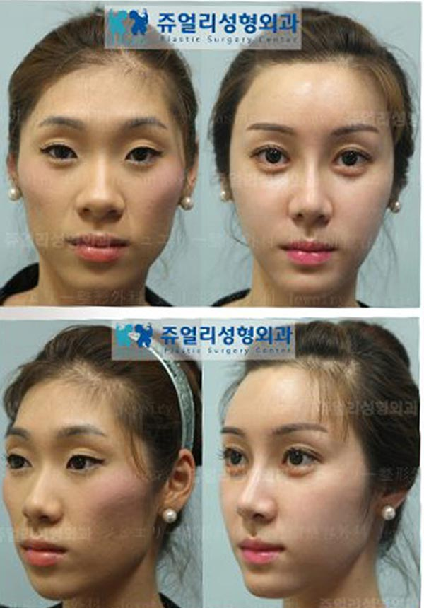 Vams reccomend Asian face reconstructive surgery