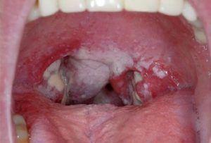 best of Sex Sore oral throat gonorrhea