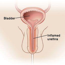 Urethral inflammation from masturbation