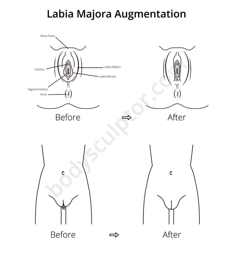 Recovery labiaplasty clitoris swollen