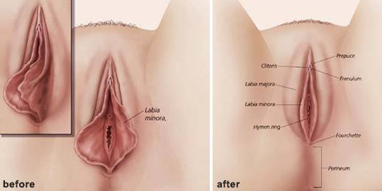 Hannibal reccomend Recovery labiaplasty clitoris swollen
