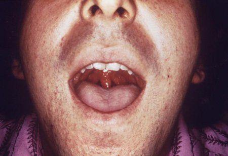 Lava reccomend Sore throat gonorrhea oral sex