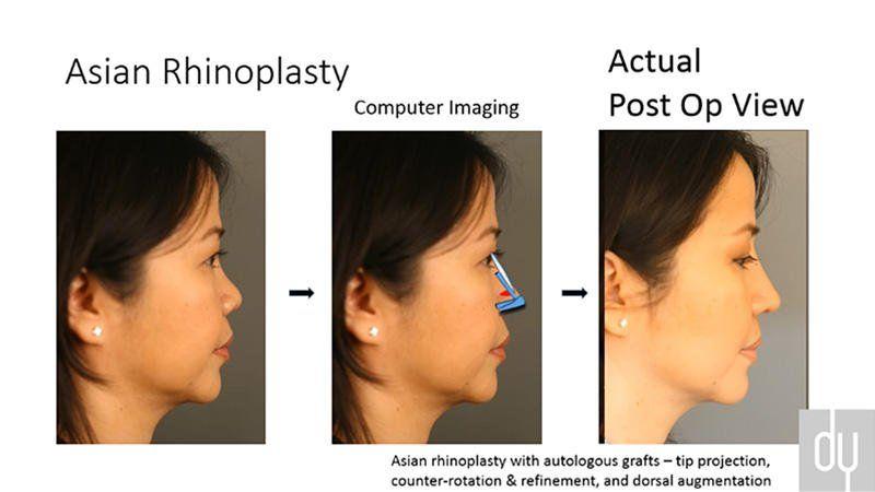 best of Photo rhinoplasty Asian
