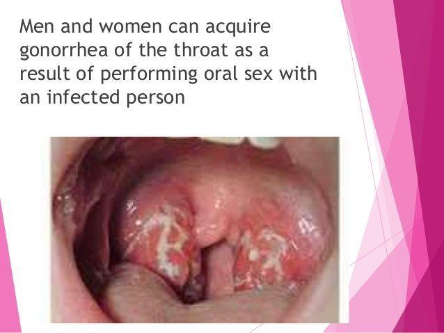 Sore throat gonorrhea oral sex