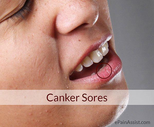 Cancre sores and facial pain
