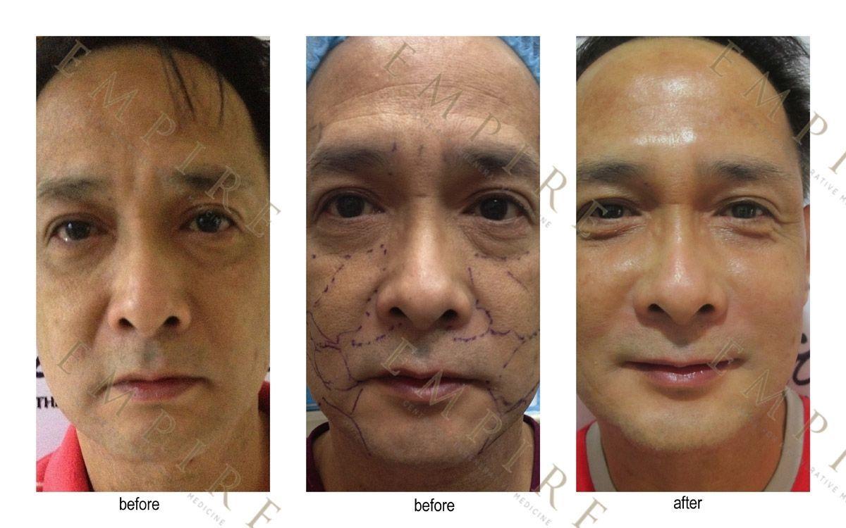 best of Reconstruction in the philippines Facial rejuvenation