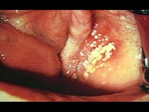 best of Yeast infection vaginal Multiple