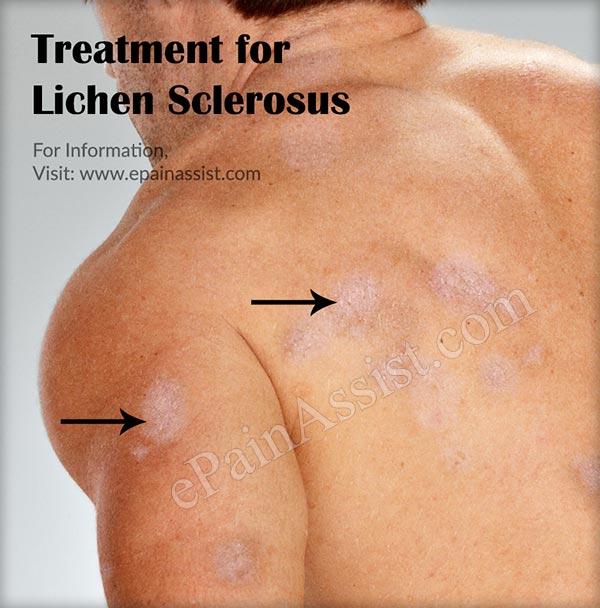 Lichen sclerosis and anus