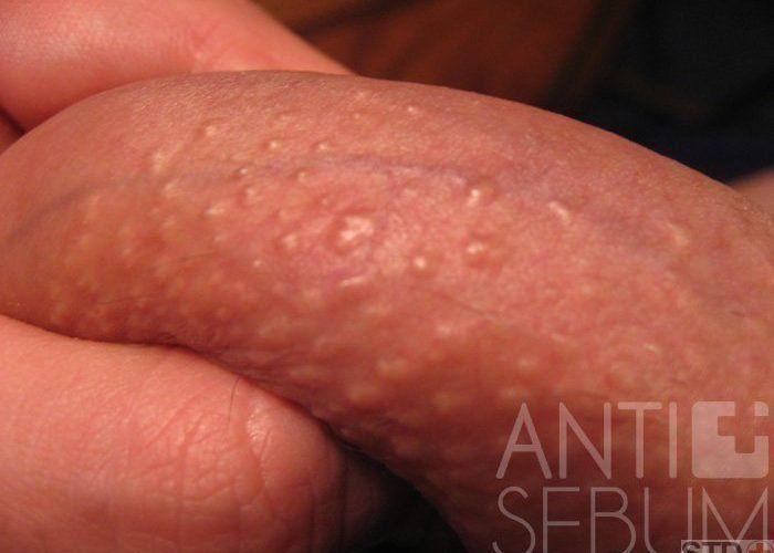 best of Hole Red tip inflamed penis