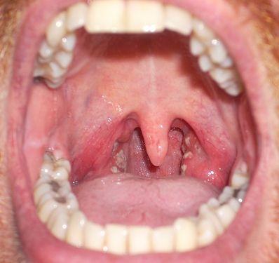 Sore throat gonorrhea oral sex