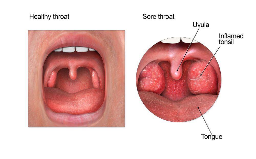 best of Infection Adult throat