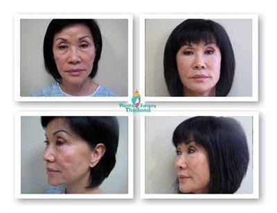 best of Reconstruction in the philippines Facial rejuvenation