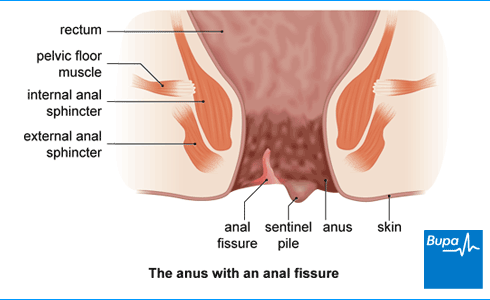 best of You an do How anal fissure treat