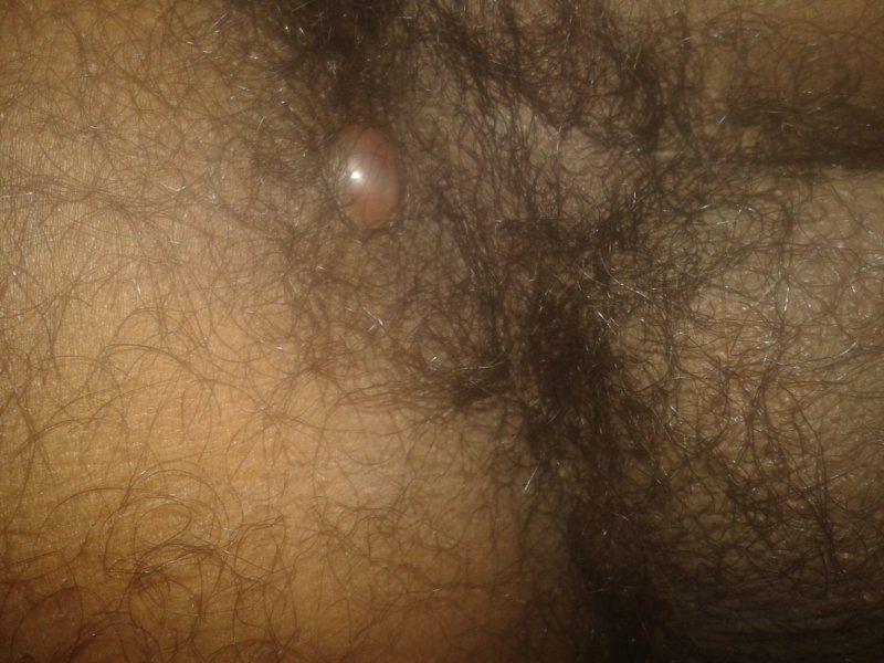 Lumps in anus