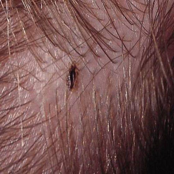 Subzero reccomend Adult lice pic