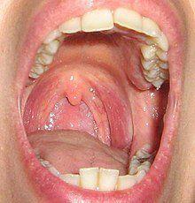 Adult throat infection