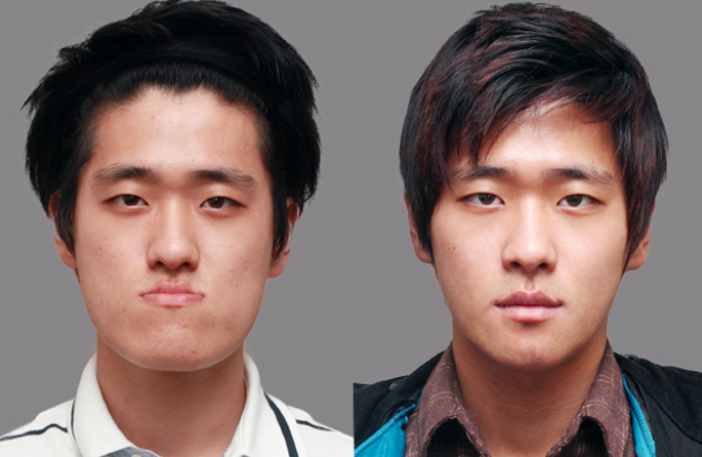 best of Face surgery Asian reconstructive
