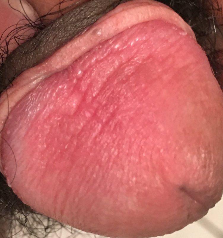 Red inflamed penis tip hole