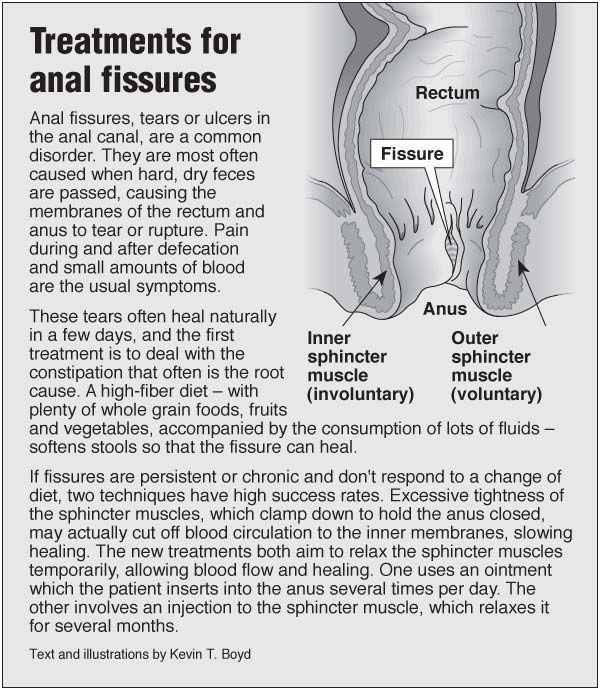 How do you treat an anal fissure