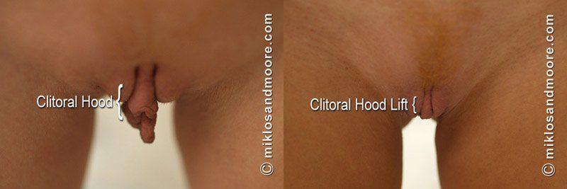 Handyman reccomend Clitoris reduction surgery