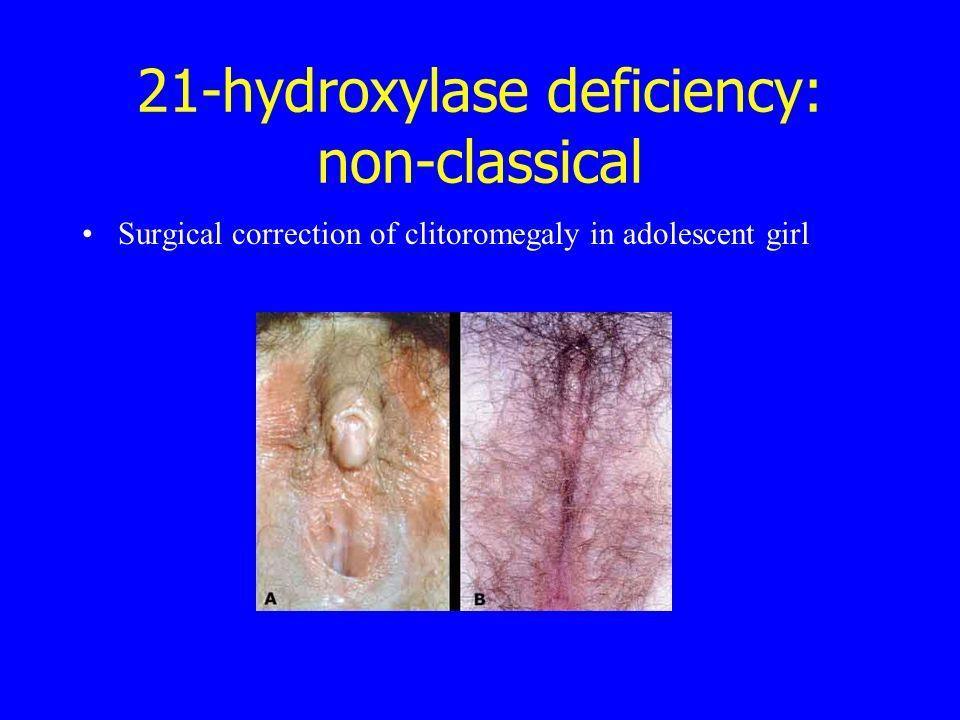 Cali reccomend Clitoromegaly and clitoris soreness