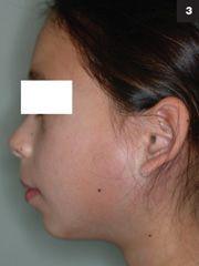 best of Edema pain Facial ear
